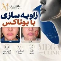 بزرگترین مرکز بوتاکس زاویه سازی بابوتاکسچروک تعریق