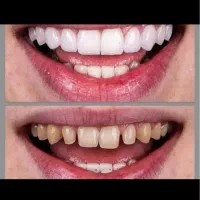 جشنواره دندانپزشکی با اقساط ویژه|خدمات آرایشگری و زیبایی|قم, شهرک فاطمیه|دیوار