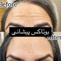 بوتاکس توسط پزشک جهت رفع چین و چروک و لیفت ابرو|خدمات آرایشگری و زیبایی|یزد, |دیوار