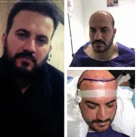 جشنواره کاشت تخصصی مو‌فقط 8/900با ضمانت