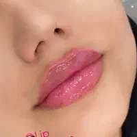 تخفیف ویژه ژل بوتاکس کاشتمو مزوژل جوانساز ژل لب
