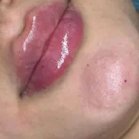 ( فیلر و بوتاکس )