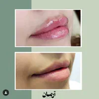 کانتورینگ با فیلر و ژل و لب تخصصی (کاملا طبیعی)|خدمات آرایشگری و زیبایی|مشهد, گلبرگ شمالی|دیوار