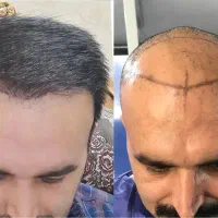 کاشت مو بدون درد و ورم (بدون تراشیدن مو)|خدمات آرایشگری و زیبایی|تهران, صادقیه|دیوار