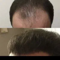 جشنواره یلدایی کاشت موشیرازی از۱۳تومن|خدمات آرایشگری و زیبایی|تهران, صد دستگاه|دیوار