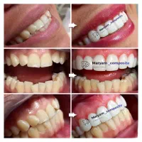 کامپوزیت دندان تعرفه دولتی|خدمات آرایشگری و زیبایی|کارون, |دیوار