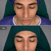 جشنواره زیبایی عمل بینی رینوپلاستی سیما سرچشمه|خدمات زیبایی و سلامت|اردبیل, |دیوار