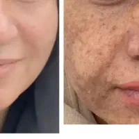 مخصوص پوست‌های کدر و دارای لک
