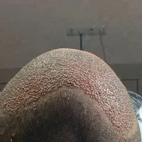 کاشت موی طبیعی فول تراکم|خدمات آرایشگری و زیبایی|ساری, |دیوار