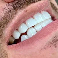کامپوزیت دندان /طرح لبخند( اقساط)|خدمات آرایشگری و زیبایی|مشهد, راهنمایی|دیوار