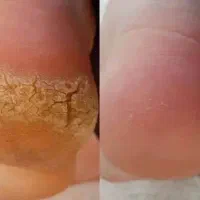 کاشت ناخن و پدیکور پا