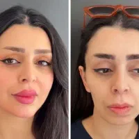 آموزش فیلر ژل بوتاکس نخ لیفت لیزر مو فشیال حجامت|خدمات آموزشی|اصفهان, هزارجریب|دیوار