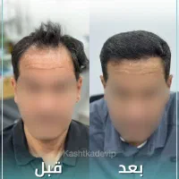 کاشت مو با شرایط استثنائی ( ظرفیت محدود )