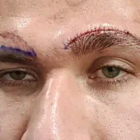 لیفت ابرو شقیقه و بلفارو ساکشن غبغب و خط سوتین