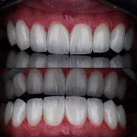 دندانپزشکی،ایمپلنت،لمینیت|خدمات آرایشگری و زیبایی|قم, عمار یاسر|دیوار