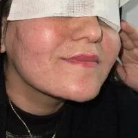 تزریق ژل فیلر و بوتاکس ۱۰ سیسی فقط ۳.۵۰۰