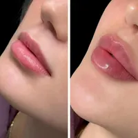 جشنواره ژل و فیلر بوتاکس پی آر پی مزو جوانساز لیزر|خدمات آرایشگری و زیبایی|رشت, گلسار|دیوار