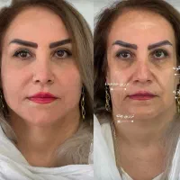 تزریق تخصصی ژل وبوتاکس،هایفو،پاک کردن تتوتوسط پزشک|خدمات آرایشگری و زیبایی|کرمانشاه, |دیوار