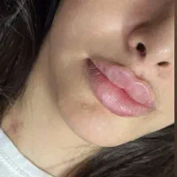 زیبایی چهره هارا ماندگار کن با بوتاکس و فیلر|خدمات آرایشگری و زیبایی|سبزوار, فرهنگیان|دیوار