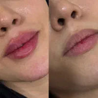 رفع کک ومک ژل بوتاکس جوانسازی رفع اسکار