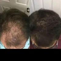 ریزشمو  ریزشمو ارثی وهورمونی  و سکه ای