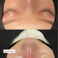 جشنواره عمل بینی به سبک جراحان ترکیه|خدمات آرایشگری و زیبایی|لامرد, |دیوار