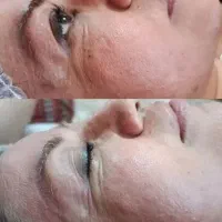 فشیال تخصصی، درمان لک و جوش، روشن‌سازی پوست