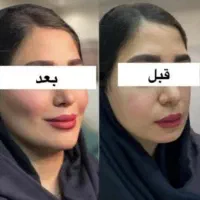 تخفیف عجیب و غریب جوانسازی و فیلر(توسط پزشک)