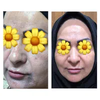 پاک کردن تتو از بین رفتن لک و روشن کردن پوست