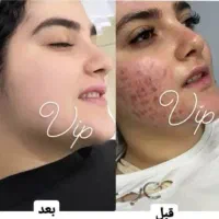 فرمول کرم سفید کننده قوی صورت ودستوپا تضمینی|آرایشی، بهداشتی، درمانی|ایرانشهر, |دیوار