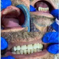 دندانسازی ((دندان مصنوعی))|خدمات آرایشگری و زیبایی|ارومیه, |دیوار