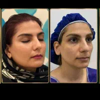 آموزش جراحی صورت کاشت ابرو بلفاروپلاسی ساکشن غبغب|خدمات آموزشی|اصفهان, خواجو|دیوار