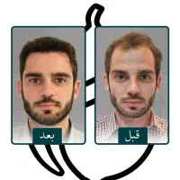 کاشت مو طبیعی و با ضمانت دائمی با تیم کامل پزشکی