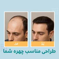 پیوند/ مو ابرو / روش DHI / با خط رویش پنهان|خدمات آرایشگری و زیبایی|تهران, دروس|دیوار