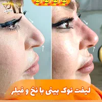 تزریق انواع بوتاکس  ژل آنزیم بینی نخ جوانسازی|خدمات آرایشگری و زیبایی|صدرا-فارس, فاز ۱|دیوار