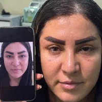 تزریق ژل و بوتاکس|خدمات آرایشگری و زیبایی|ارومیه, |دیوار