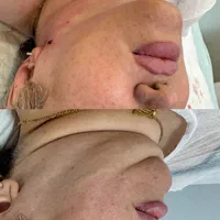 تزریق چربی صورت\فیلرلب/فیلربادی/بوکالفت/غبغب|خدمات آرایشگری و زیبایی|تهران, عبدلآباد|دیوار