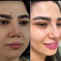 کوچک شدن بینی تضمینی فقط با ۵ میلیون|خدمات آرایشگری و زیبایی|تهران, هاشمی|دیوار