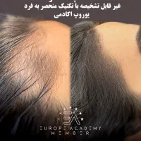 اسکالپ سر، خداحافظی با کم‌پشتی مو