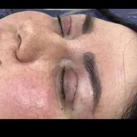 عمل بلفاروپلاستی،عمل غبغب