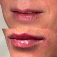 تزریق و آموزش فیلر و بوتاکس با ارائه مدرک|خدمات آرایشگری و زیبایی|کرج, چهارصد دستگاه|دیوار
