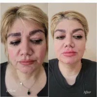 خدمات و آموزش تخصصی ژل و بوتاکس|خدمات آرایشگری و زیبایی|کرج, کیانمهر|دیوار