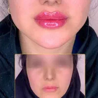 کلینیک تزریق ژل390لیفت بوتاکس لیزر /جالپرو پروفایل