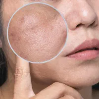 prp ومیکرونیدلینگ