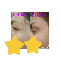 لیزرموهای زائد بوتاکس هایفوتراپی مزوتراپی