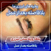 بلفاروپلاستی(جراحی پلک بالا و پایین)توسط چشم پزشک|خدمات آرایشگری و زیبایی|یاسوج, |دیوار