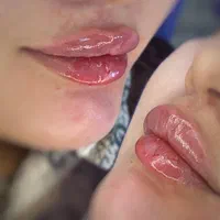 تخفیف فیلر صورت با ۱۱۰۰|خدمات آرایشگری و زیبایی|پارس‌آباد, |دیوار