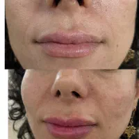 ژل لب،زاویه سازی،فیلر چانه،فول فیس|خدمات آرایشگری و زیبایی|مشهد, عسگریه|دیوار