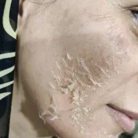 الگاپیل (پوست ماری)