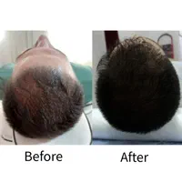 رویش تضمینی مو با تکنیک پیشرفته مزوتراپی|خدمات آرایشگری و زیبایی|کرمانشاه, |دیوار